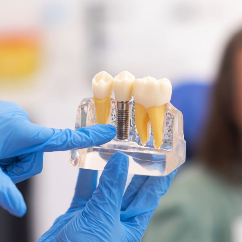 Cómo cuidar los implantes dentales