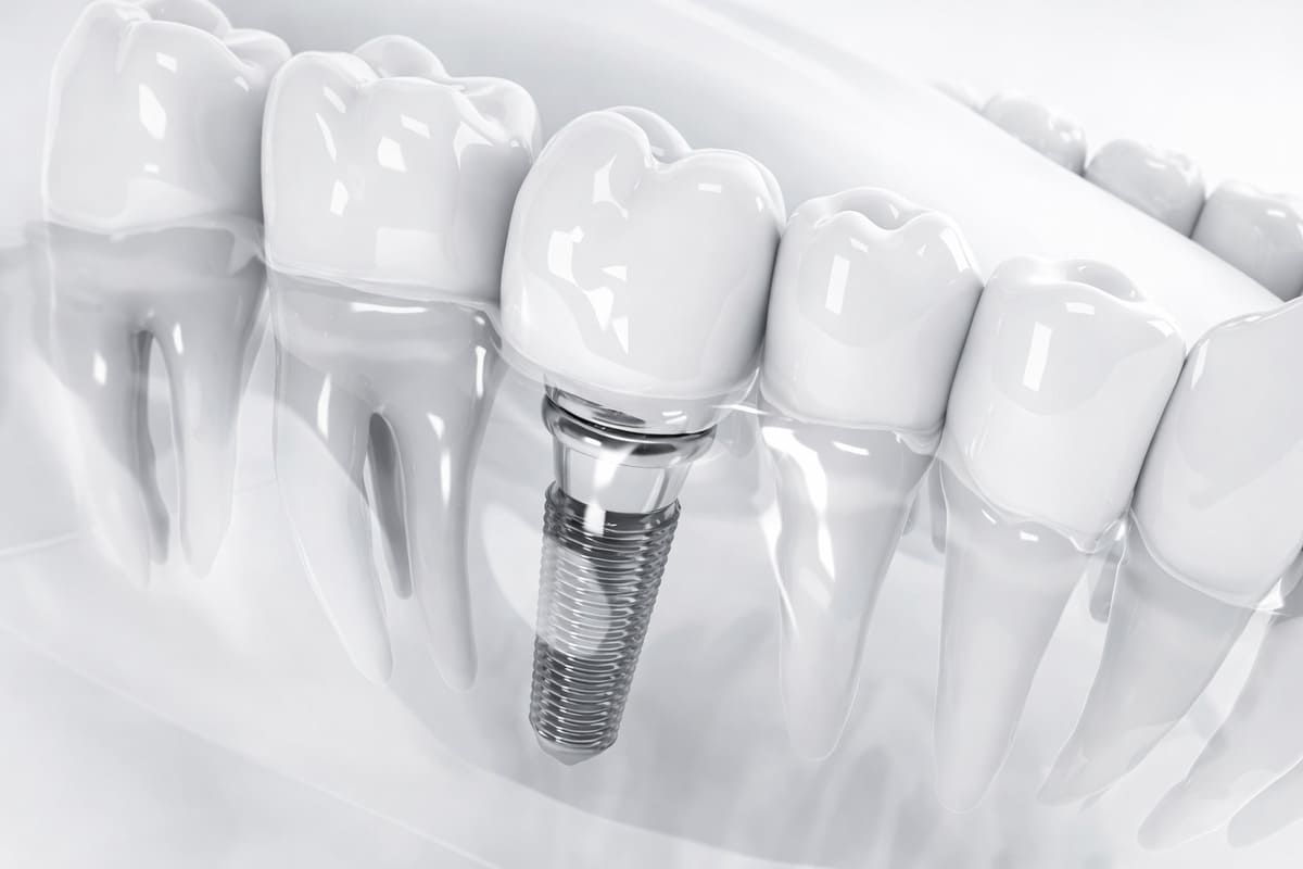 Implantes dentales inmediatos: cuándo se pueden colocar en el mismo día