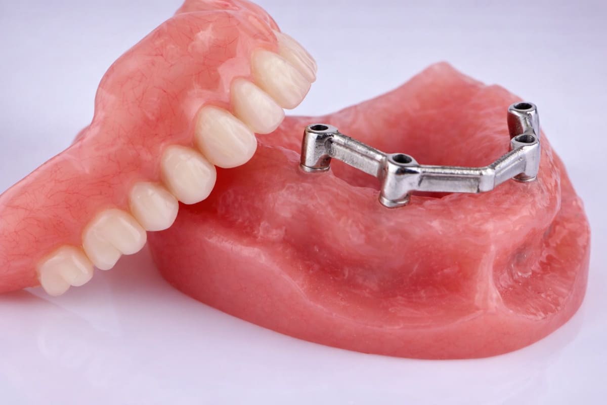 Prótesis sobre implantes: tipos, ventajas y cuál ofrece mayor estabilidad