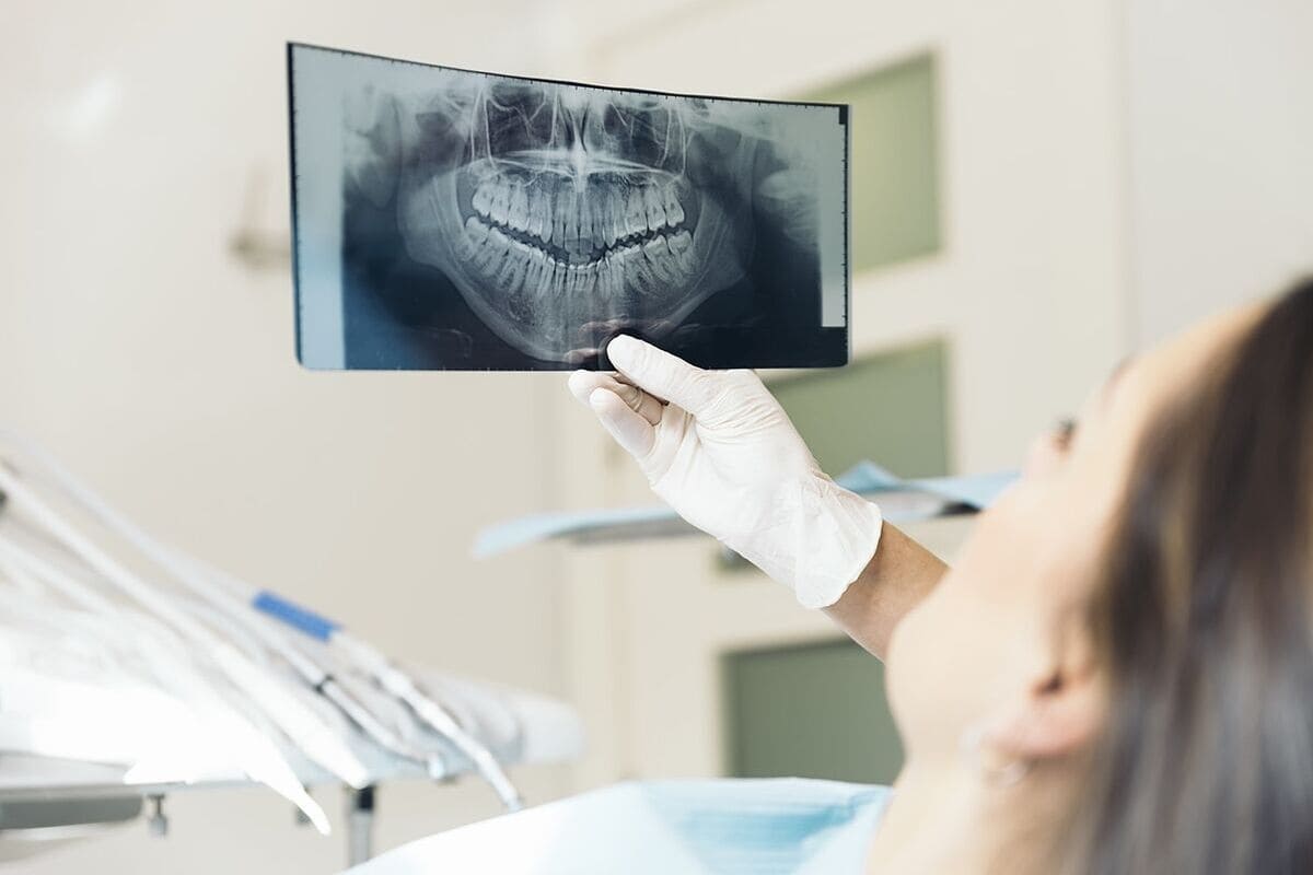 Implantes dentales en pacientes con poco hueso